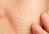 Close-up of skin with visible pores and finger