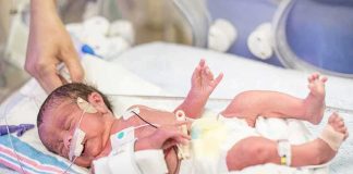 Premature newborn in NICU with monitoring tubes